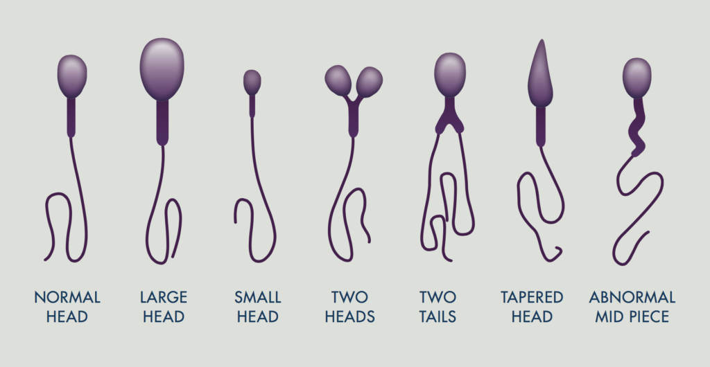 Semen Abnormalities 