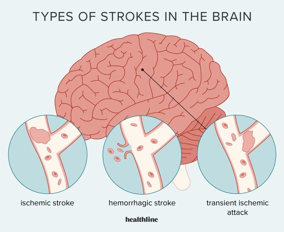 Dr. Philips Says Avoiding Doggy Style Prevents Stroke 