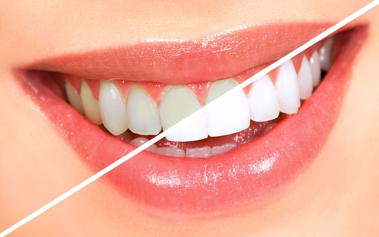 teeth whitening scaled